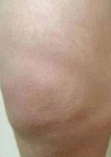 Глибоке проникнення та щоденний догляд при діабетичній нейропатії