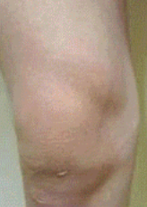 Глибоке проникнення та щоденний догляд при діабетичній нейропатії