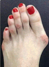 Глибоке проникнення та щоденний догляд при діабетичній нейропатії