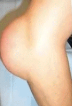 Глибоке проникнення та щоденний догляд при діабетичній нейропатії